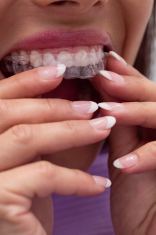Apparecchi ortodontici - Studio Dentistico Di Bartolo Genova
